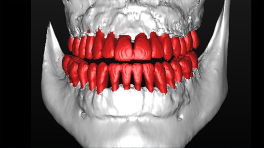 CBCT — Nine months post-treatment