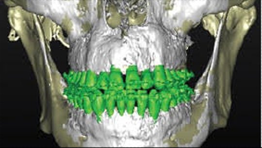 CBCT — Post-SFOT phenotype-modified result